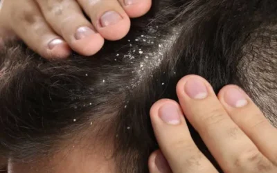 La temporada seca es la agravante de la caspa, ayudando la humedad del calor: dermatólogo