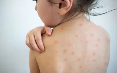 Sinaloa suma 11 casos de sarampión y enfrenta brote de dengue en El Dorado: Secretaría de Salud intensifica acciones de prevención