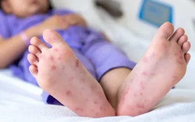 Sector salud detecta casos de enfermedad “mano, pie y boca” en Guasave, aunque no generan alarma