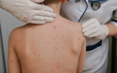 Culiacaneses Conocen los Riesgos del Sarampión y Cómo Prevenirlo: Un Compromiso Comunitario con la Salud