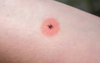 Incrementan casos de rickettsia en Ahome; de 12 sospechosos 7 han sido confirmados