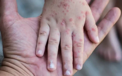 Confirman 42 casos de virus Coxsackie en escuelas de la región del Évora.