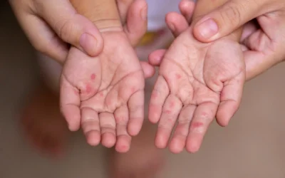 Llaman a la población a no alarmarse con el aumento de casos de coxsackie, ya que en la mayoría de los pacientes no tiene repercusiones graves.