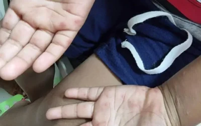 Detectan dos casos de virus Coxsackie en Guardería del ISSSTE en Guasave.