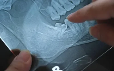 La extracción de terceros molares es recomendable para evitar apiñamiento de los dientes: Odontóloga