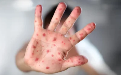 Canadá pierde certificación como país libre de sarampión; México en riesgo por baja cobertura de vacunación