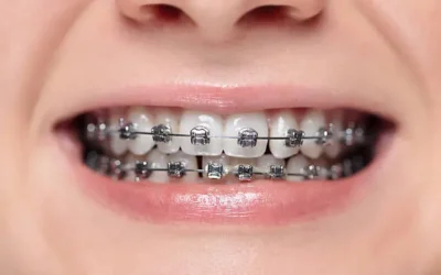 La rehabilitación dental amerita contemplar el germen de los terceros molares para evitar resultados indeseados: Odontóloga