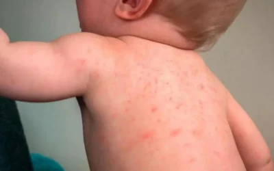 Dengue en menores: Hospital Pediátrico de Sinaloa llama a reforzar la prevención