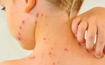 Confirman tres casos de sarampión en niños atendidos en el Hospital Pediátrico de Sinaloa