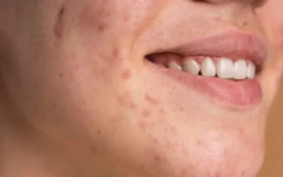 Las hormonas pueden afectar la piel de las mujeres con acné incluso después de la adolescencia: Dermatólogo