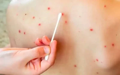 Confirman primera muerte por sarampión en Sinaloa; era una mujer de 34 años no vacunada