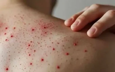 Confirman primer caso de sarampión en Guasave; reforzarán vacunación.