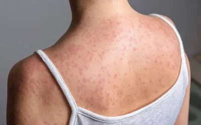 Este año, se tiene un registro de160 casos de sarampión, reporta Prevención y Promoción de la Salud