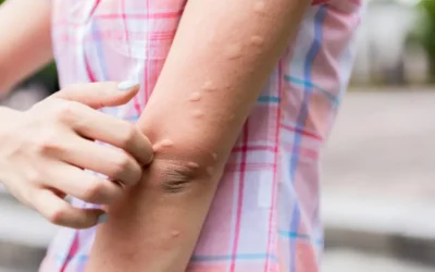 Aumentan riesgos por picaduras ante llegada del calor en Culiacán