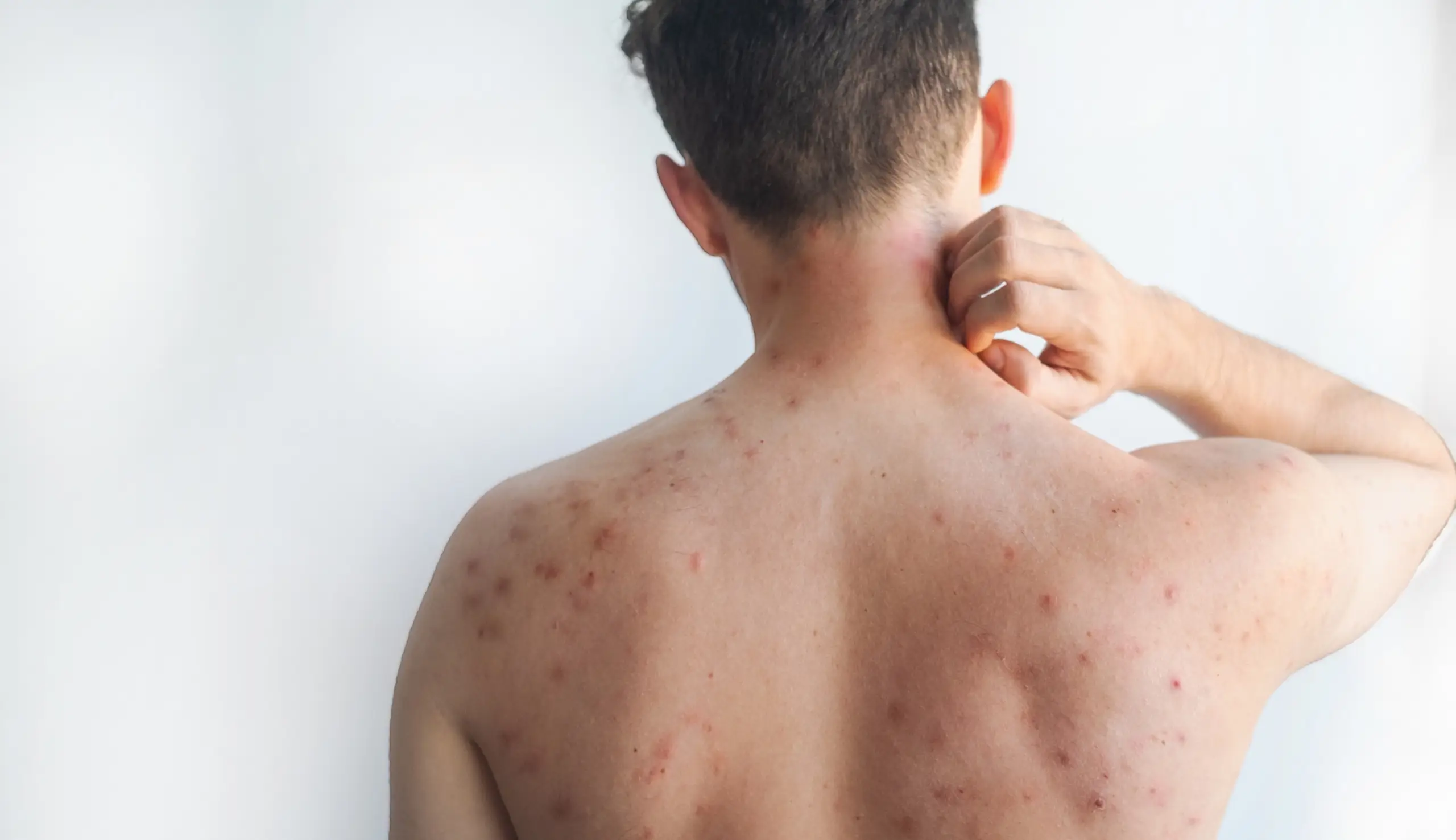 Alerta Sanitaria en México: El sarampión se dispara y supera los 15 mil casos en 2026